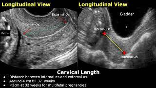 How To Measure Cervical Length On Ultrasound | Transabdominal And Transvaginal Views | Cervix USG