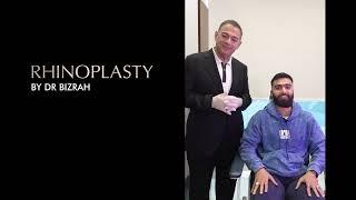  Elevating Aesthetics: A Patient’s Deep Dive into Rhinoplasty with Dr. Bizrah 