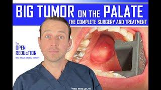 BIG TUMOR on PALATE: the FULL SURGERY