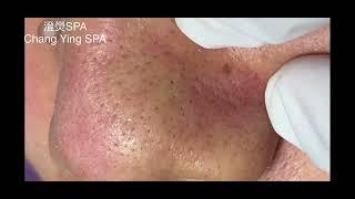 鼻子粉刺清除「中壢清粉刺」「中壢做臉」Nose comedone & blackhead cleaning