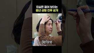 같은 사람 맞아? 중년 성형 레전드 후기 #shorts