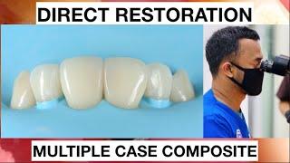 Step by step Layering Anterior Multiple Case Composite | General Dentist Griya RR