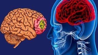 Brain Hypoxia: Causes And Symptoms