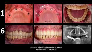 Dr Siewert - Factors for Success with JUVORA implant prosthetics