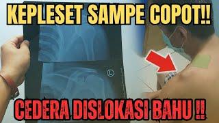 AKIBAT KEPLESET SAMPE COPOT‼️CEDERA DISLOK BAHU GESERNYA JAUH‼️