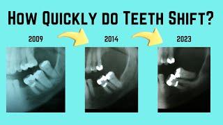 How Quickly do Teeth Shift ?