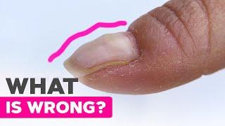 Fixing Deformed Nails | Nail Strengthening | Bubble Nail Design