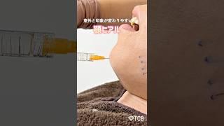 【糸リフト】人気のプチ整形#shorts