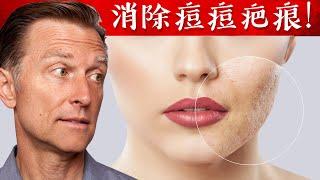 【皮膚】消除痘痘疤痕的最好方法,自然療法,柏格醫生 Dr Berg