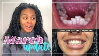 March Invisalign Update