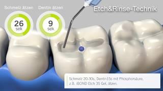 Tipps und Tricks – iBOND Universal – verschiedene Bondingtechniken