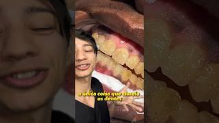 Assim é Feito o Clareamento Dental Profissional no Dentista!! #shorts