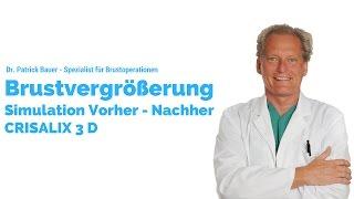 Brustvergrößerung - vorher nachher Simulation -  Crisalix 3D |  Spezialist für Brustoperationen