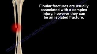 Fibular Fracture ,isolated- Everything You Need To Know - Dr. Nabil Ebraheim