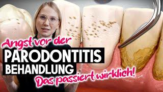 Behandlung unter dem Zahnflleisch! 50% der Bevölkerung werden diese Erfahrung machen | Parodontitis