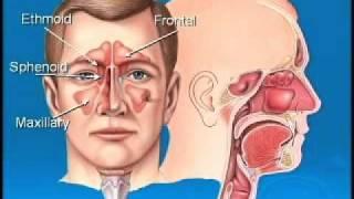 Squeezing the Stuffiness Out of Sinuses