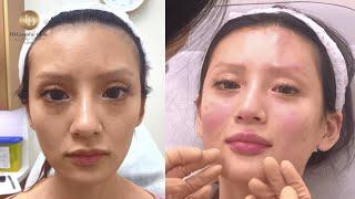 改变病弱刻薄感面相｜徐医生素人改造计划｜ID医美诊所 ID Cosmetic Clinic