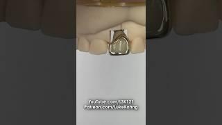 Cementing a Gold Facing #dental #teeth #smile #shorts #shortvideo #gold #implant #implants #cement