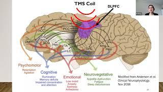 Transcranial Magnetic Stimulation for Treatment-Resistant Depression