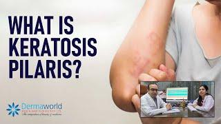 What is Keratosis pilaris? #DermaworldDelhi #DrRohitBatra #DrAishwaryaDua #KeratosisPilaris