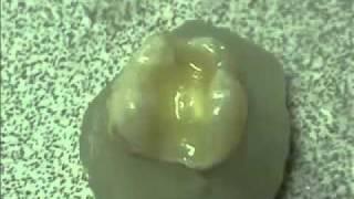 Sure Dental Surpass Instructions - YouTube.flv