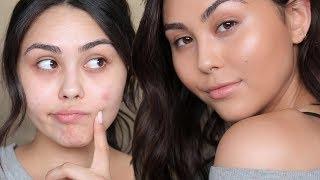NO MAKEUP MAKEUP LOOK TO COVER ACNE | Roxette Arisa