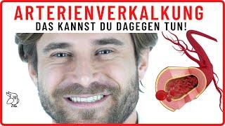 ARTERIENVERKALKUNG ENTFERNEN 8 Tipps um deine Arterien zu reinigen – Arteriosklerose vorbeugen