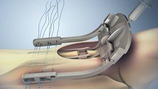 Achilles Tendon Rupture and Repair