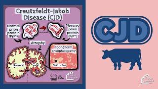 Creutzfeldt -Jakob Disease (CJD)