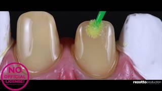 Restorative Dentistry Procedure [Patrick´s Story]