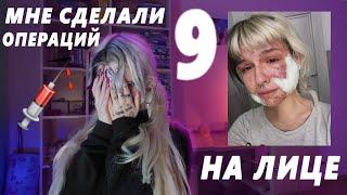 мне сделали 9 ОПЕРАЦИЙ на лице за 1,5 месяца...