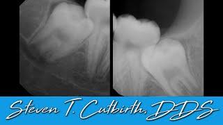 Improve Your Wisdom Teeth Extraction Technique - Dental Minute with Steven T. Cutbirth, DDS