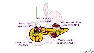 Cystic Neoplasms of Pancreas