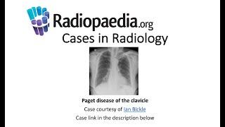 Paget disease of the clavicle (Radiopaedia.org) Cases in Radiology