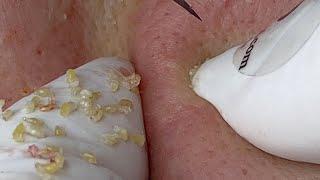 Super Large Hidden Acne Under The Skin | Mụn Ẩn Siêu To Dưới Da - SacDepSpa#223