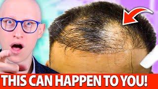 Hair Transplant Clinics You MUST Avoid!