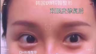 韩国双眼皮修复专门-DH枓翰顶尖眼部修复