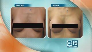 Dr. Kotoske explains breast augmentation at Cosmetic Surgery Institute