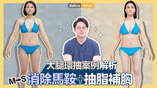 大腿環抽案例大解析！消除馬鞍+抽脂補胸+擺脫副乳｜周杰醫師