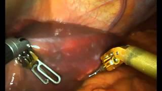 Firefly HCC Liver Resection