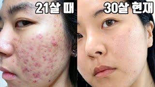 30년 여드름 경험으로 깨.달.은 색소침착 특징과 없애는 법 + 효과본 성분 소개