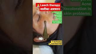 Melasma treatment with leech therapy #ayurveda #melasma #pimples#acnetreatment #pigmentation#shorts