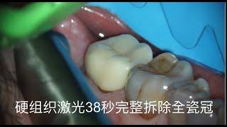 硬组织激光38秒完整拆除全瓷冠