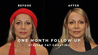 STELLAR FACIAL FAT GRAFTING UPDATE: ONE MONTH AFTER SURGERY