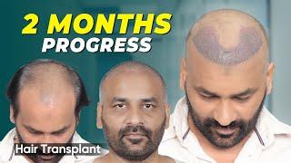 Hair Transplant in Jodhpur | Best Results & Cost of Hair Transplant in Jodhpur