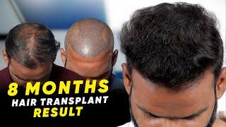 Hair Transplant in Chennai | Best Results & Cost of Hair Transplant in Chennai