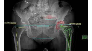 Manual Hip Plan in mediCAD 2D