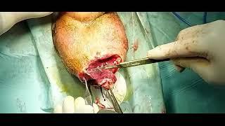 Giant scrotal abscess- not for people with an upset stomach