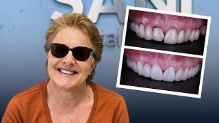 Zirconia Crowns Cost in Mexico - Save up to 50% at Sani Dental Group