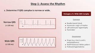 Intro to EKG Interpretation - A Systematic Approach